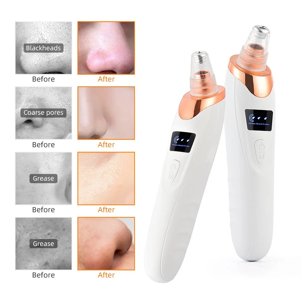 Nose Blackhead Remover