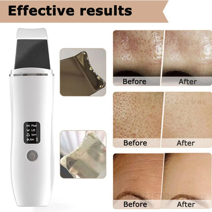 Ultrasonic Skin Scrubber & Pore Cleaner